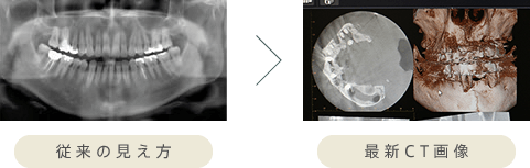 従来の見え方と最新CT画像の比較
