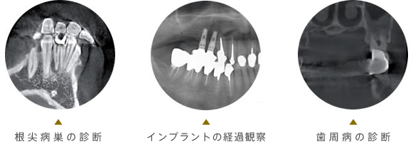 根尖病巣の診断、インプラントの経過観察、歯周病の診断